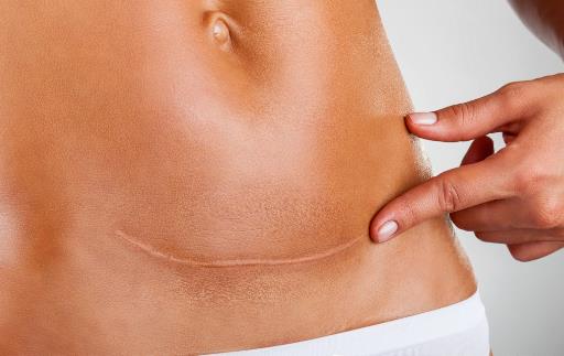 剖腹产的伤口该拿你怎么办 如何防止剖腹产疤痕增生-很美的