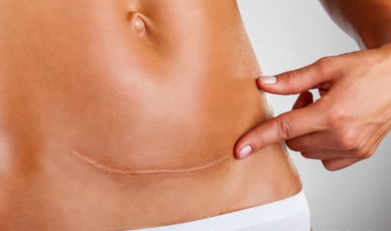 细数剖腹产的七大危害 剖腹产坐月子注意事项-很美的