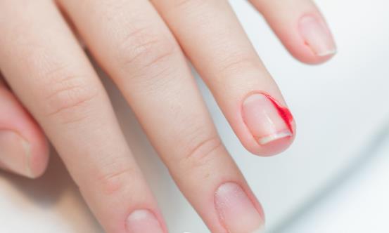 倒刺虽小处理不好会出大问题 预防倒刺有妙招-很美的