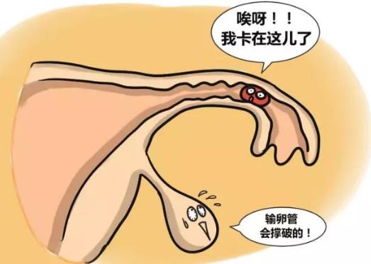 输卵管妊娠的自我检查、症状及治疗方法-很美的