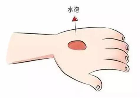 烫伤的水泡能挑破吗 科学处置烧烫伤方法-很美的