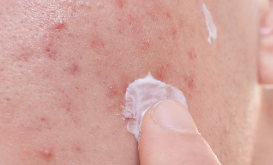 血热体质火气上升烦躁 调理血热多喝点菊花水-很美的