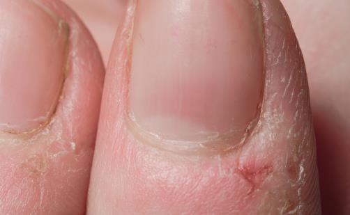 冬天手指周围总是长倒刺 到底是不是缺乏维生素-很美的