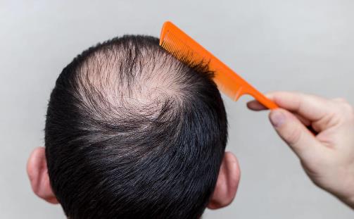 当代压力大脱发的人越来越多 冬日防秃的日常妙招-很美的