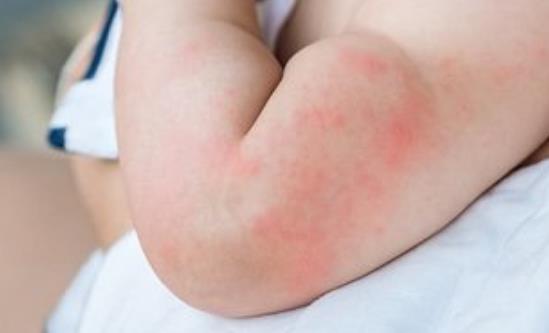 荨麻疹影响生活工作 荨麻疹的治疗方法-很美的