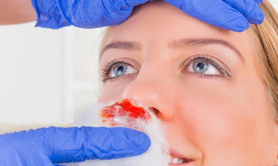 好用的止鼻血的方法 食物也能治疗流鼻血-很美的