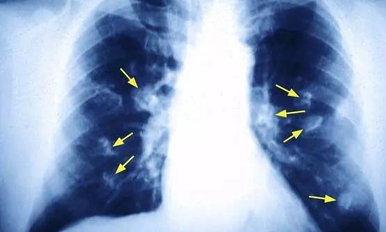 揪出引发女性肺癌的罪魁祸首 厨房油烟的危害超乎想象-很美的