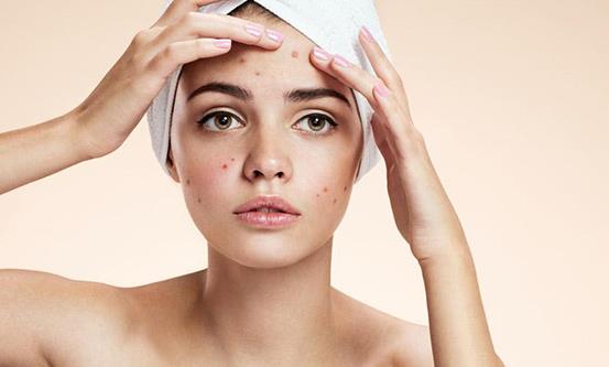 脸上痘痘多影响个人颜值 14个偏方轻松甩掉痘痘-很美的