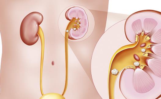 肾结石出现的六大原因 预防肾结石复发的饮食调理-很美的