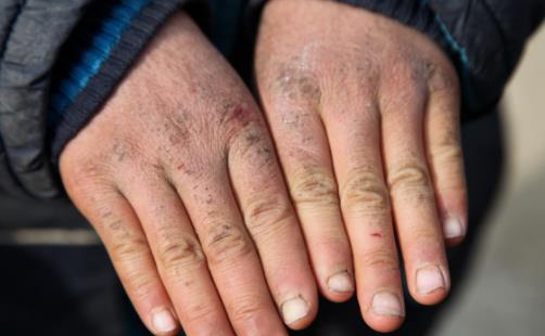 冬季长冻疮太难受 自制冻疮膏让你的双手恢复如初-很美的