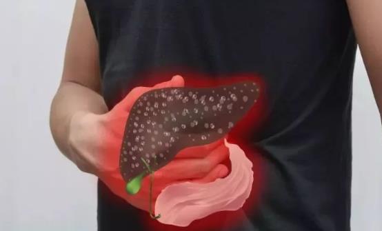 治疗黄疸型肝炎的9则小偏方 能有效治疗黄疸型肝炎-很美的