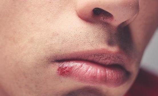 凛冬已至嘴唇总是干裂起皮发炎 冬天常见的嘴唇问题分析-很美的