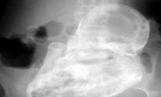 太吓人，82岁老太太查出竟怀孕40年-很美的