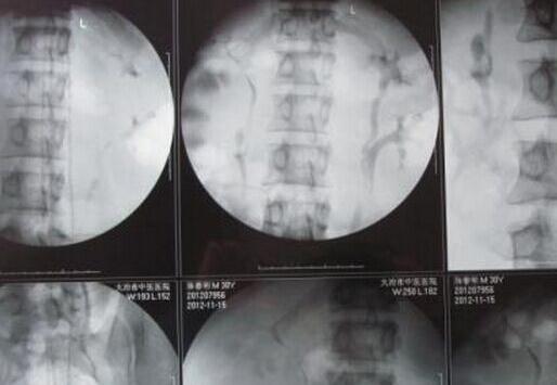 男子体内长四个肾,可以买肾6了-很美的