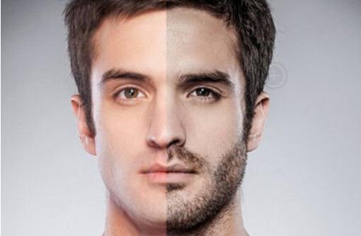 娃娃脸男人选择胡须移植-很美的