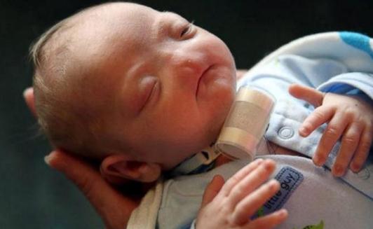 没有鼻子的婴儿,妈妈说他是完美的-很美的