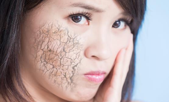 冬季皮肤干燥是怎么回事 皮肤干燥要怎么缓解-很美的