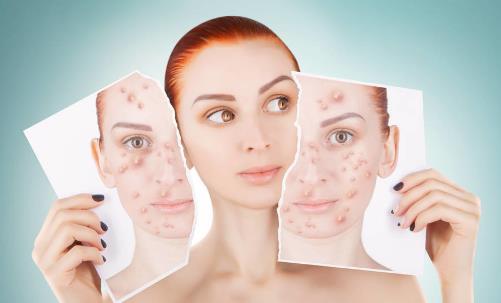 内分泌六项面部长痤疮 痤疮的食疗方推荐-很美的