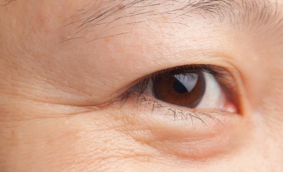 皮肤水分不足易导致眼角皱纹 常做眼部运动告别眼角皱纹-很美的