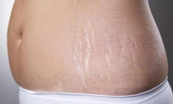 肥胖纹是爱美女士心里的痛 肥胖纹该怎么做才能去除-很美的
