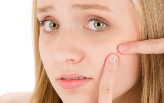 易生痘痘的人 去除痤疮产生的印记小妙招-很美的