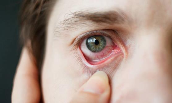 红血丝青睐眼部和脸上 要怎么有效摆脱?