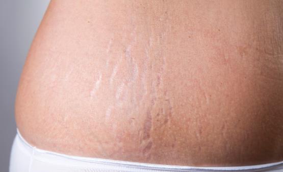 肥胖纹怎么消除 饮食合理规律作息肥胖纹也不再可怕-很美的