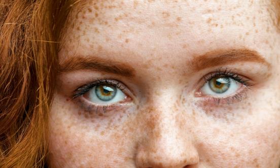 激光祛斑会不会反弹 适合激光祛斑的人群