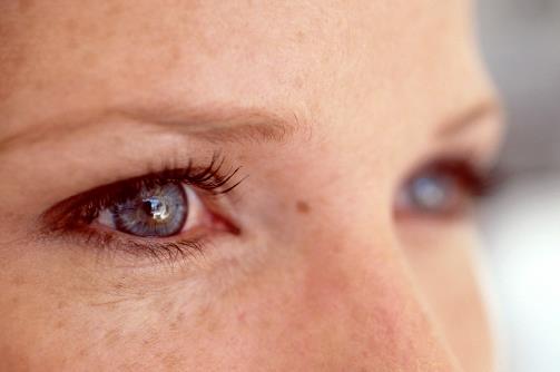 有的人割双眼皮却不好看 内眦赘皮使双眼皮效果不好-很美的